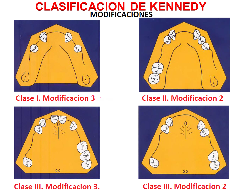 clasificacion de kennedy con modificaciones