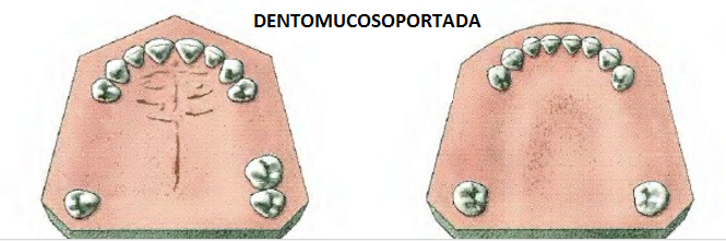 DENTOSOPORTADA